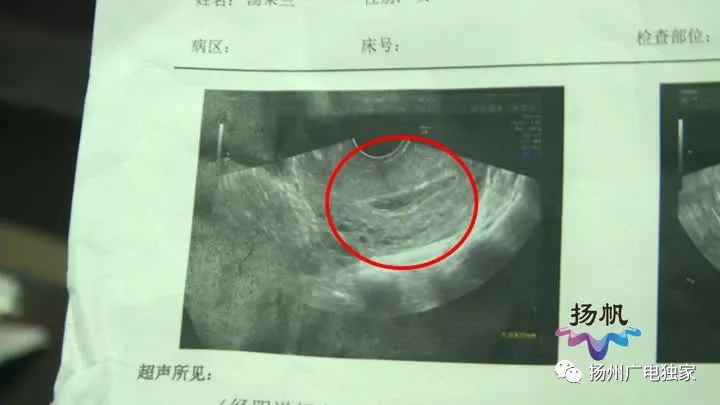 扬州女子子宫大出血,女人肚子胀突然出血