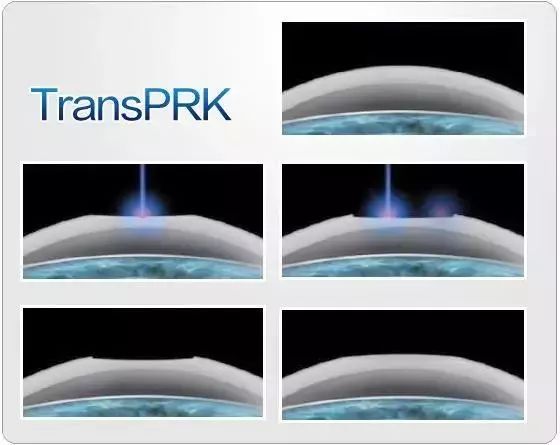 800度近视也能矫正吗,15岁近视800度增长得很快怎么办