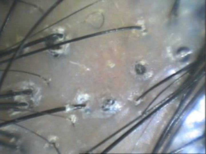 12岁女儿头皮屑为什么那么多,12岁女孩头皮屑多痒怎么回事