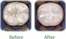 进行防龋齿牙齿窝沟封闭工作,窝沟封闭是保护牙齿最有效的方式