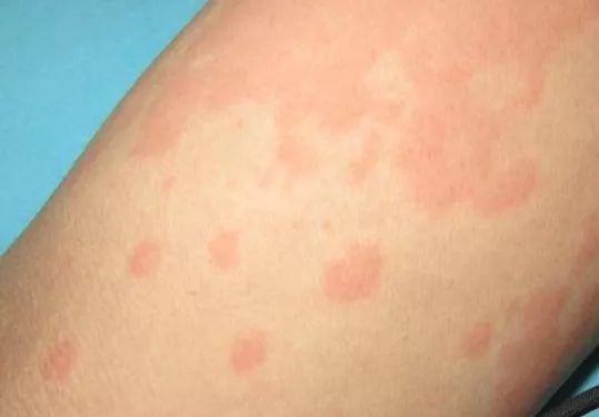 吃完大闸蟹呼吸困难,吃完大闸蟹下腹难受