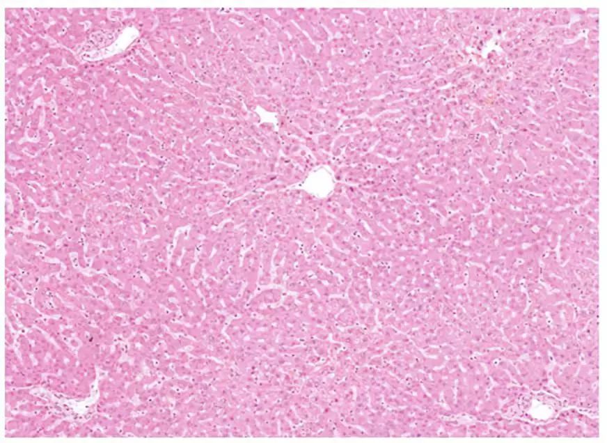 精华回顾｜肝胆精英荟：肝脏炎症性损伤的临床及病理鉴别诊断——杨永峰教授