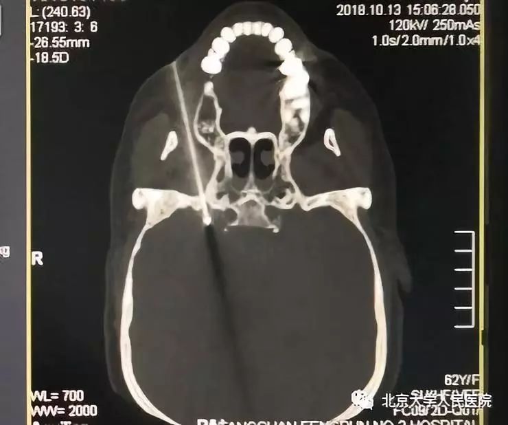 科普胸痛千万不要大意,医生科普疼痛科