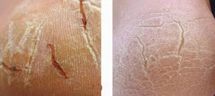 治脚气干裂起皮用什么药膏,有这个方子来治脚气就不怕复发