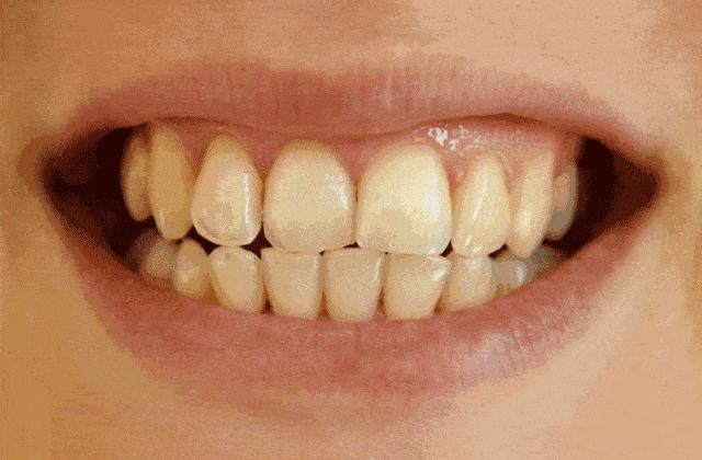 去除黄牙牙垢的牙膏,去口臭黄牙牙垢的牙膏