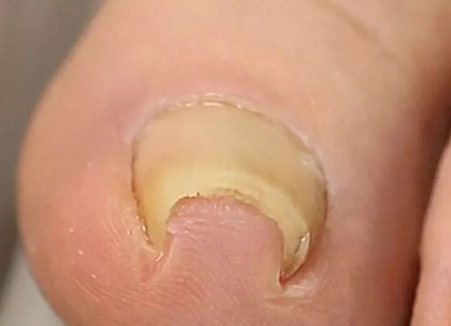 十六岁女孩六年不剪脚趾甲,11岁女孩没有剪过指甲