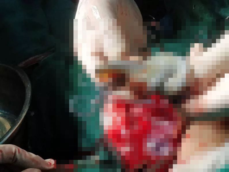 怀孕八个月胎死腹中的真实案例,33岁女子生3胎出了医疗事故