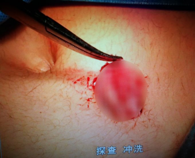 有头发、有牙齿、有颅骨!17岁女高中生肚里长了个奇怪的肿瘤,似怀孕!这类肿瘤女性生殖系统常见!