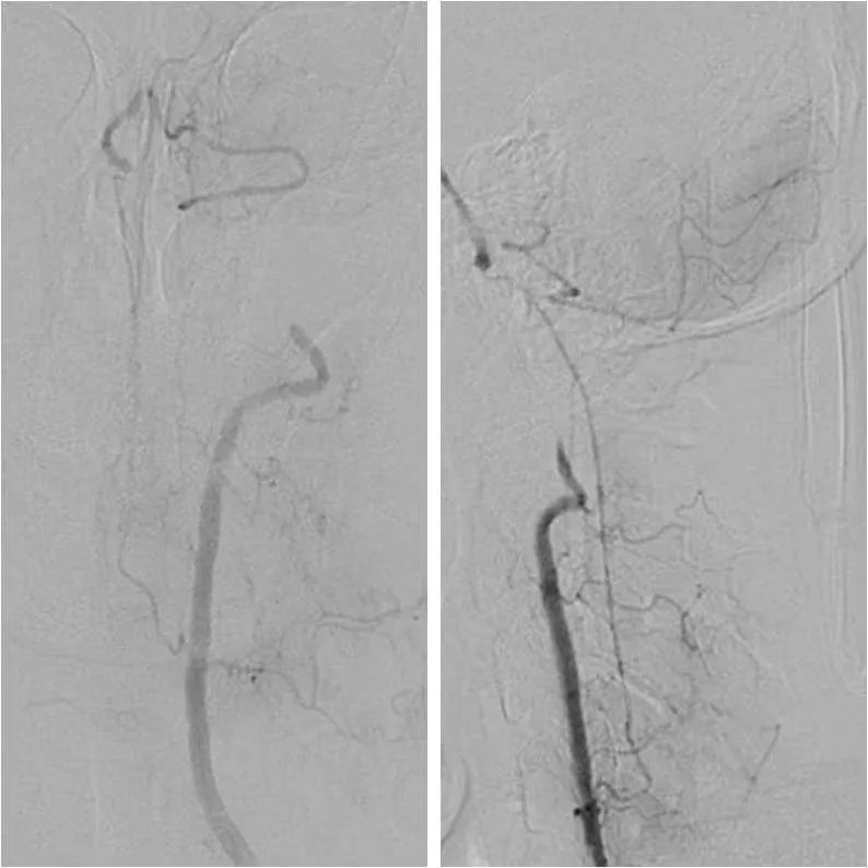 椎动脉起始段狭窄的介入治疗ppt,椎动脉v4段假性动脉瘤介入治疗