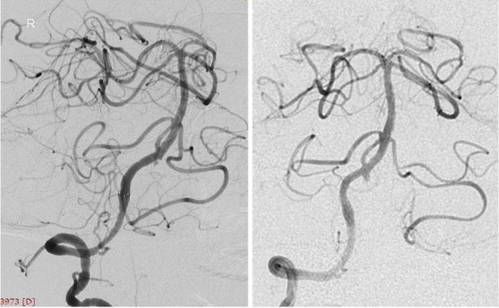 椎动脉起始段狭窄的介入治疗ppt,椎动脉v4段假性动脉瘤介入治疗