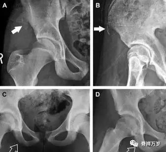 肩关节脱位易漏诊的骨折,放射科容易漏诊的骨折