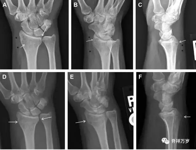 肩关节脱位易漏诊的骨折,放射科容易漏诊的骨折
