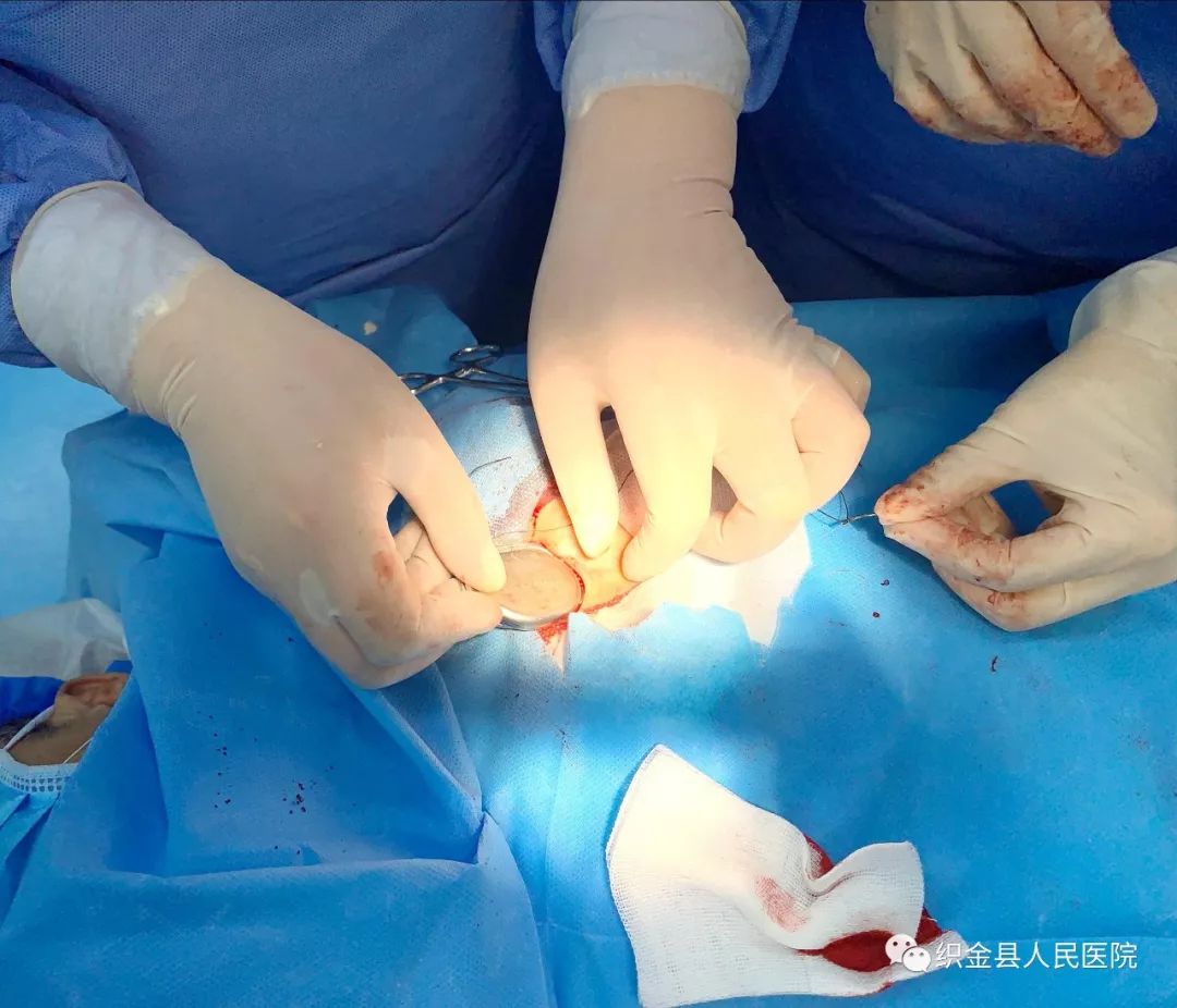 最新心脏起搏器植入示意图,心脏起搏器手术最好前十名医院