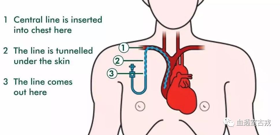 中心静脉导管使用方法视频,中心静脉导管护理技术操作标准