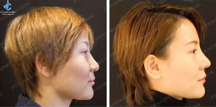 强势围观！日本最牛的一家整形医院，募集中国模特啦啦啦~