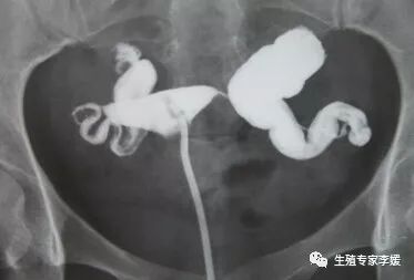 输卵管结扎有什么副作用和危害,输卵管结扎对女性有什么影响吗