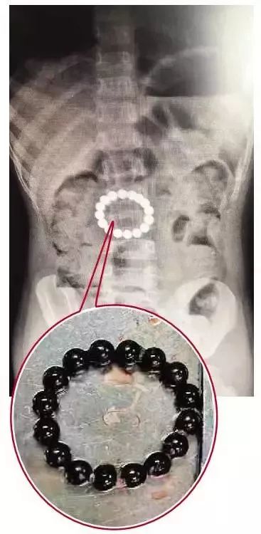 糟心熊孩子,吸铁石不小心让孩子吞了有危害吗