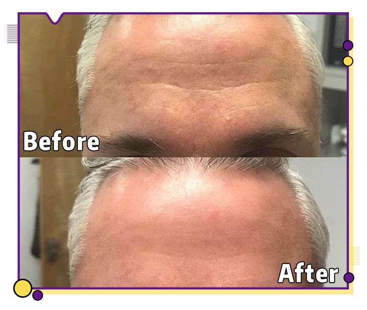 一分钟提拉紧致去除眼袋皱纹,修眼袋祛皱纹神器