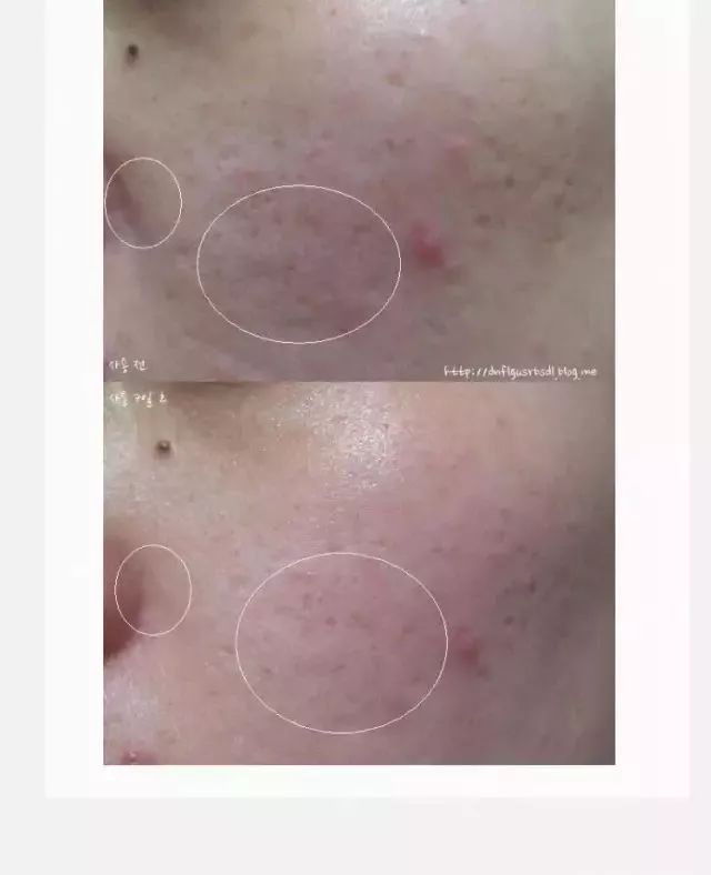 一支“激光霜”帮你解决众多困扰~