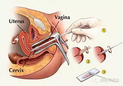 如何看懂宫颈刮片检验单,宫颈刮片报告怎么看