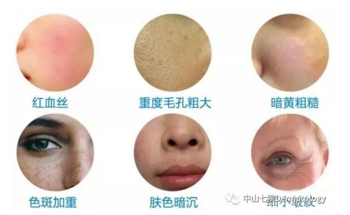 中山七院光子嫩肤特价,中山光子嫩肤推荐