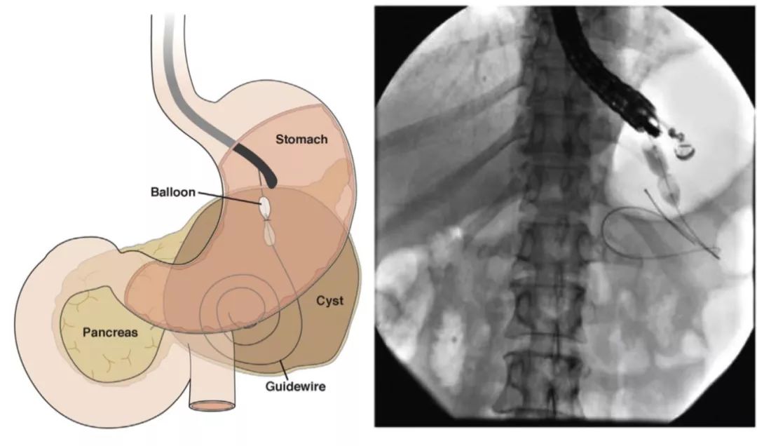 权威研究说,胰腺液体积聚引流,内镜可以这样用