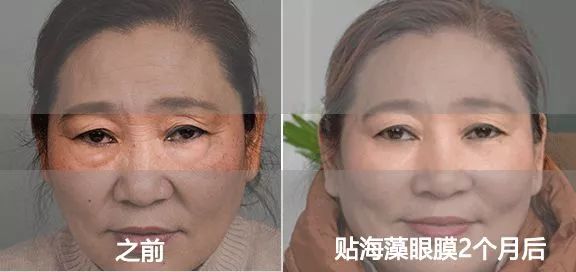 50岁没有眼袋眼纹黑眼圈,60岁去眼袋的最佳方法