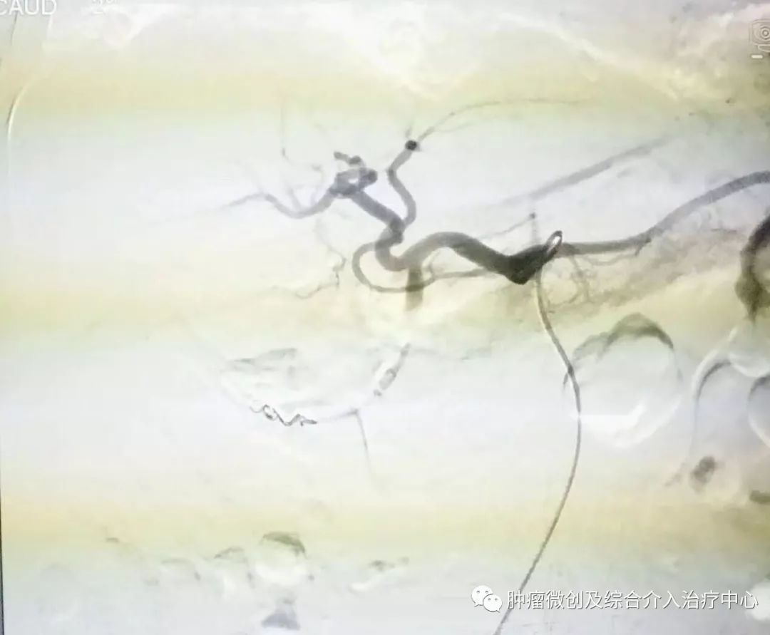 运城市第一医院肿瘤科咋样,运城第一医院治疗肿瘤怎么样