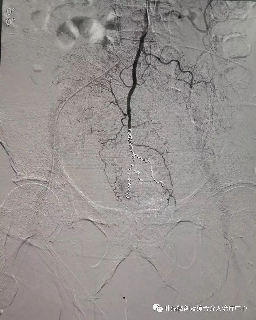 运城第一医院肿瘤介入科专家,运城市第一医院介入科专家