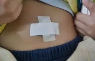 腹胀呕吐恶性肿瘤,肿瘤病人恶心呕吐缓解方法74岁