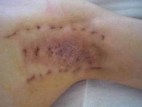 狐臭有办法解决遗传吗,狐臭有办法解决吗