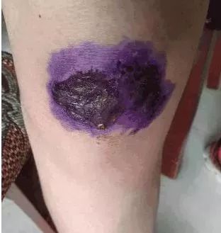 外伤是红药水好还是紫药水好,红药水紫药水叫什么