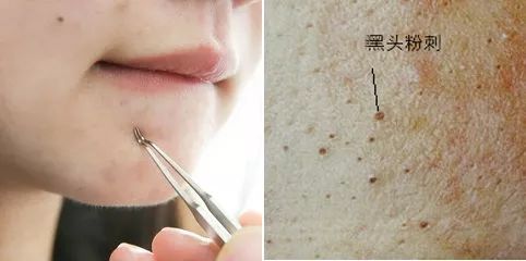 涂脸上能吸出脏东西,吸脸上毛孔里脏东西好吗