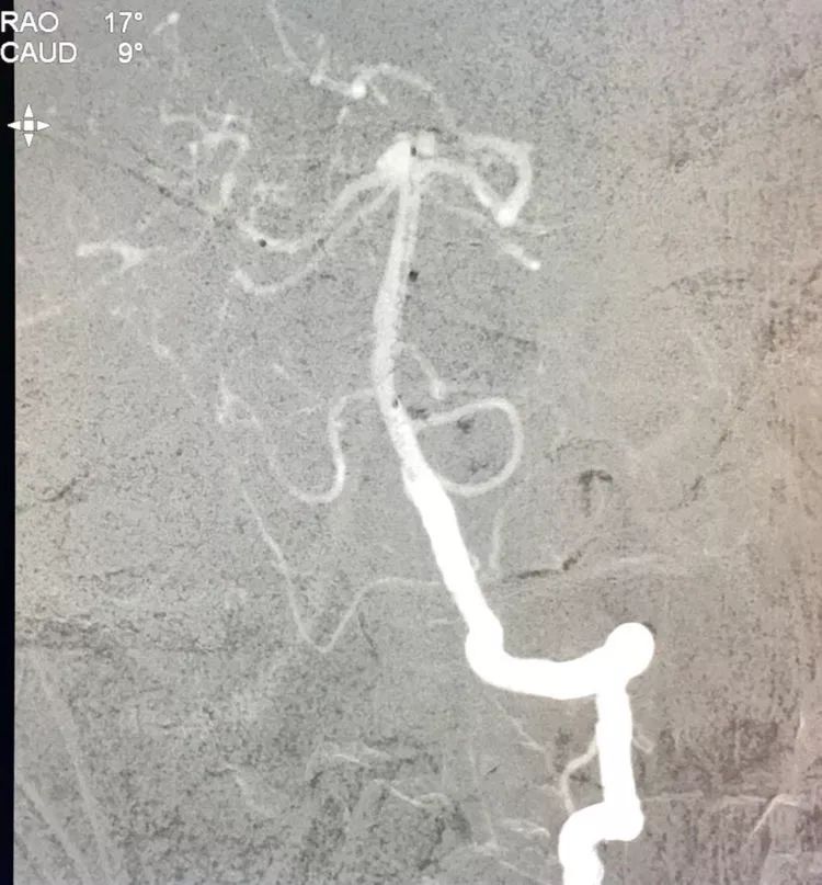 柳暗花明专栏|栓塞颅内动脉瘤时微导管无法穿过LVIS支架网眼怎么办