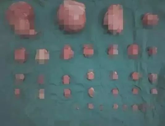 头皮要炸！未婚女子形似怀孕7个月，肚子里竟然密密麻麻都是……