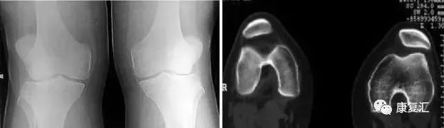膝关节不同部位疼痛的病因分析,膝关节疼痛的十大原因及治疗