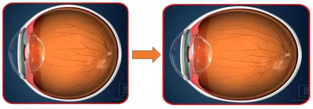 寒假了,给孩子一个轻松摘掉眼镜的机会,你还不来吗?!