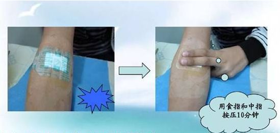 picc静脉置管维护挂哪个科好,picc置管后有什么注意事项