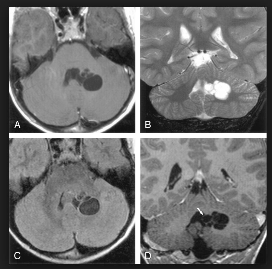 医生说脑子里有水泡是怎么回事,医生脑子有泡是怎么回事