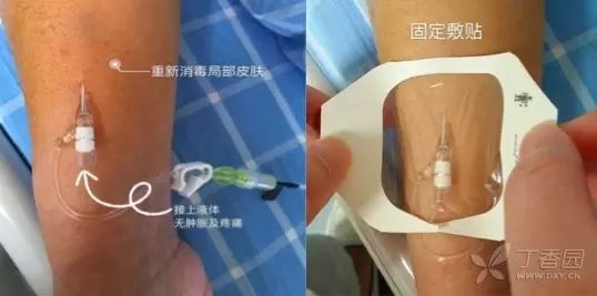 输液刺破血管补救办法,打针刺破血管是如何恢复的