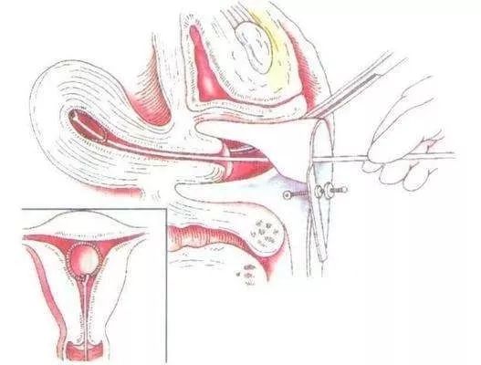 与男友共度这一夜后,24岁女孩差点……(附避孕科普)