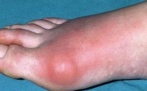 19岁男孩把饮料当水喝，结果脚痛到无法走路！爸爸惊呆……