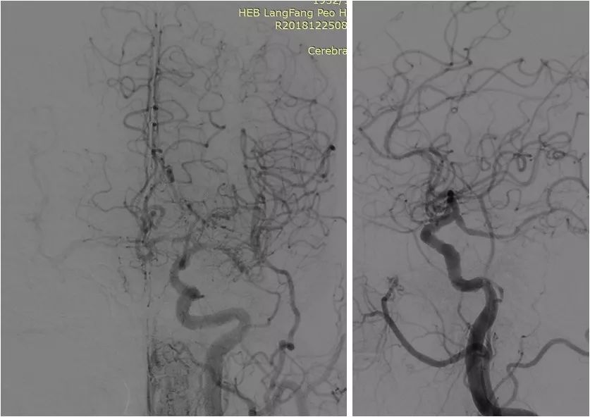 椎动脉v4段血管瘤介入治疗,臭氧治疗左侧v4段椎动脉狭窄