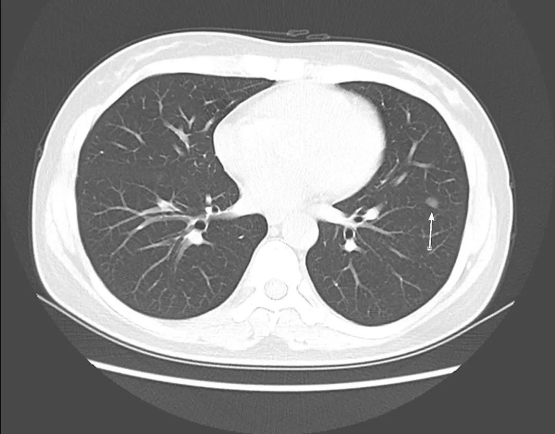 心冠动脉夹层能治愈吗,夹层动脉血管破裂症状