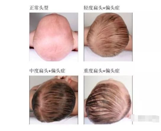 成年头型偏头怎么纠正,宝宝头型偏头会自然恢复吗