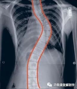 14岁男孩脊柱侧弯怎么治疗,脊柱侧弯治疗大概需要多少钱
