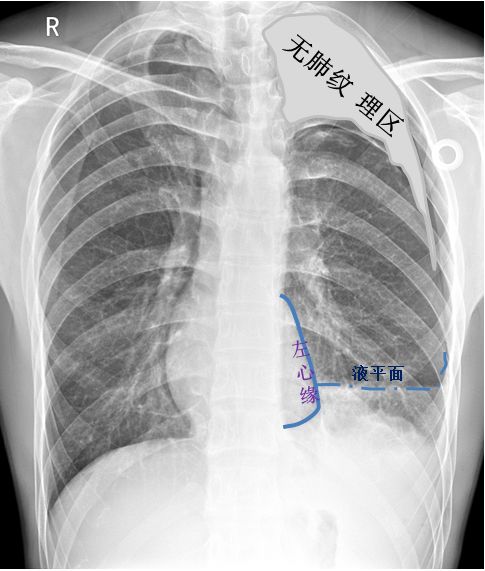 气胸的x线表现胸膜炎,胸外科气胸病人病例