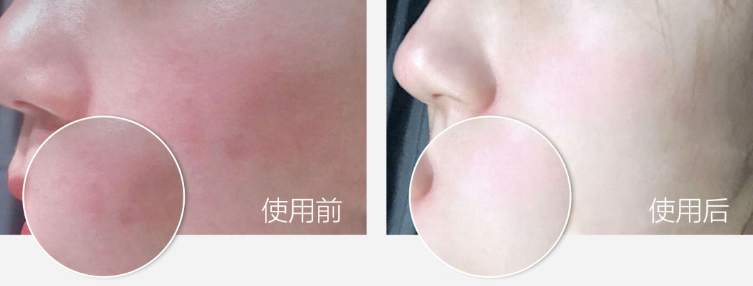 湿疹晒伤后抹什么药膏,日晒皮炎湿疹用什么止痒