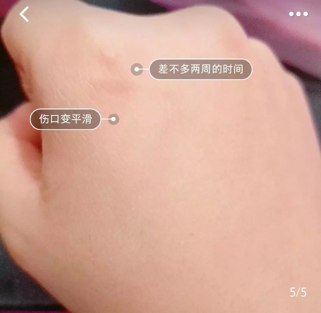 疤痕体质如何去痘印和烫伤印,烫伤色素疤痕修复的最新方法