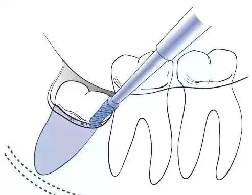 有一种痛叫做拔智齿的痛,有种疼叫智齿疼6种情况果断拔掉
